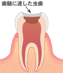 虫歯除去：歯の神経（歯髄）に達した虫歯を取り除く