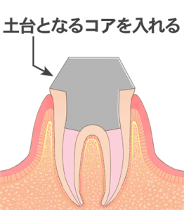 土台（コア）の作成：歯の根を密閉、歯を強化する