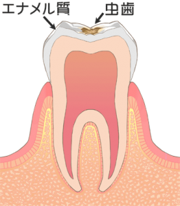 虫歯の進行　レベル１（c1）